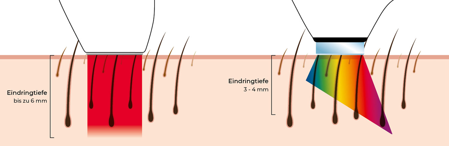 Technologie-Unterschiede Diodenlaser & IPL